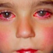 Questo bambino ha perso il 75% della sua vista per un giocattolo che probabilmente avete a casa