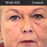 XPL, la "seconda pelle" spalmabile contro rughe e malattie