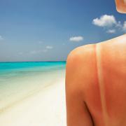 Prime scottature in spiaggia? Ecco il rimedio più efficace (e facilissimo da mettere in pratica)
