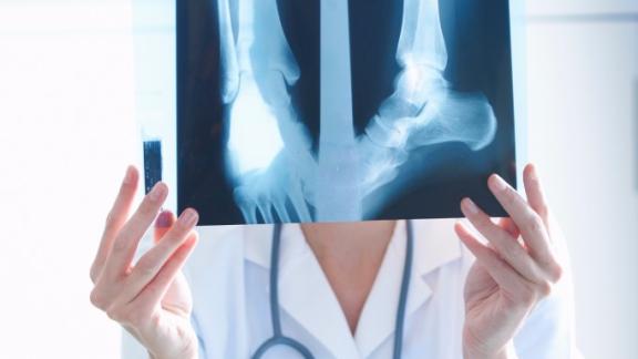 Osteoporosi e fragilità ossea: è affidabile la MOC?