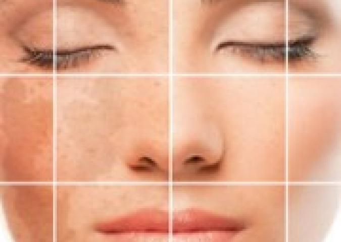 DOTT.SSA BUCCI Dermatologo plastico ed Esperto di Starbene, come eliminare le macchie scure del viso?
