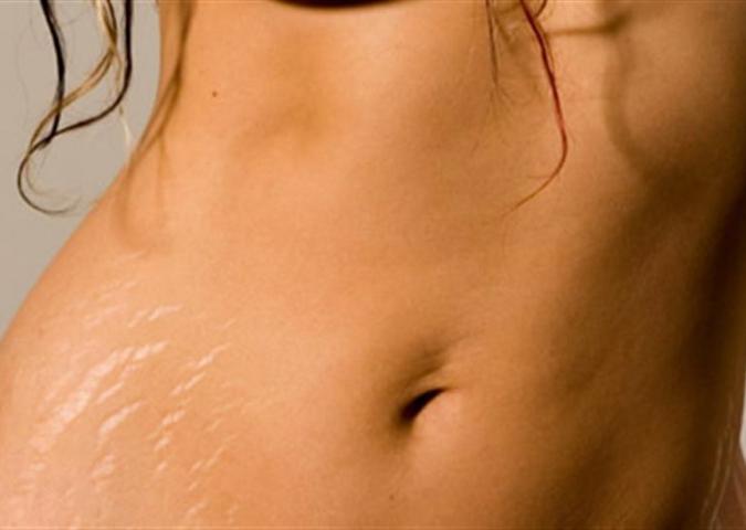 DOTT.SSA BUCCI Dermatologo plastico ed Esperto di Starbene, le smagliature si possono eliminare?